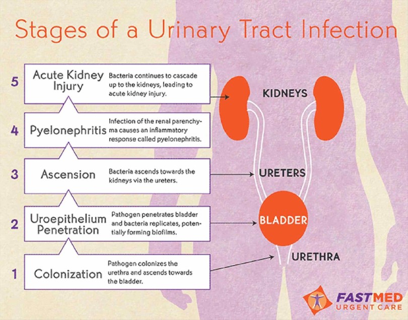 INFEKCIJE URINARNE STOP 6 MIX (Formula composita ad Infectio tractus urinarii  ICD-10 N39)