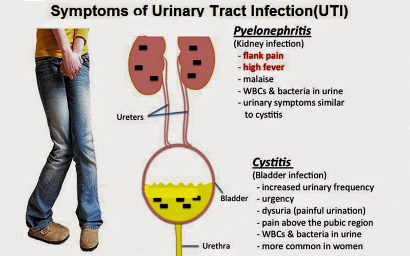 symptoms-of-UTI
