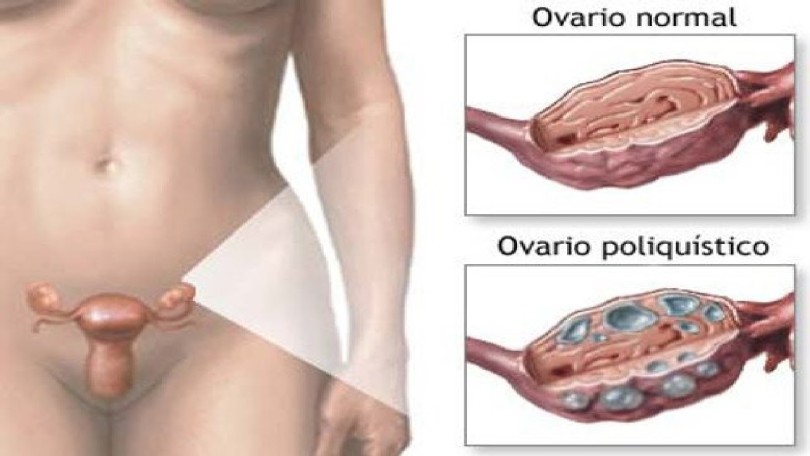 POLICISTIČNI JAJNICI STOP 6 MIX  (Formula composita ad  Syndroma ovarii polycystici E28.2 )