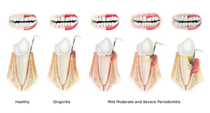 GINGIVITIS STOP 6 MIX Kompozitna formula kod gingivitisa i parodentopatije (Formula composita ad Gingivitis et morbi periodontales)