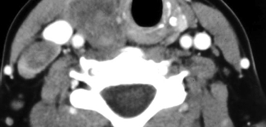 Thyroid gland 
Papillary carcinoma