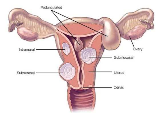 miomi uterusa d25