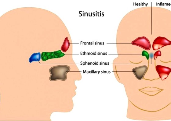 Sinusitis+