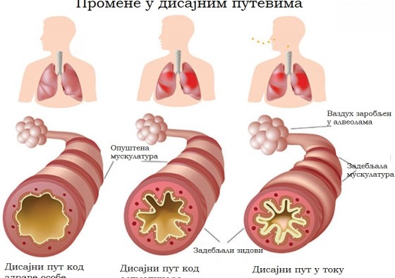 astma bronhijalna