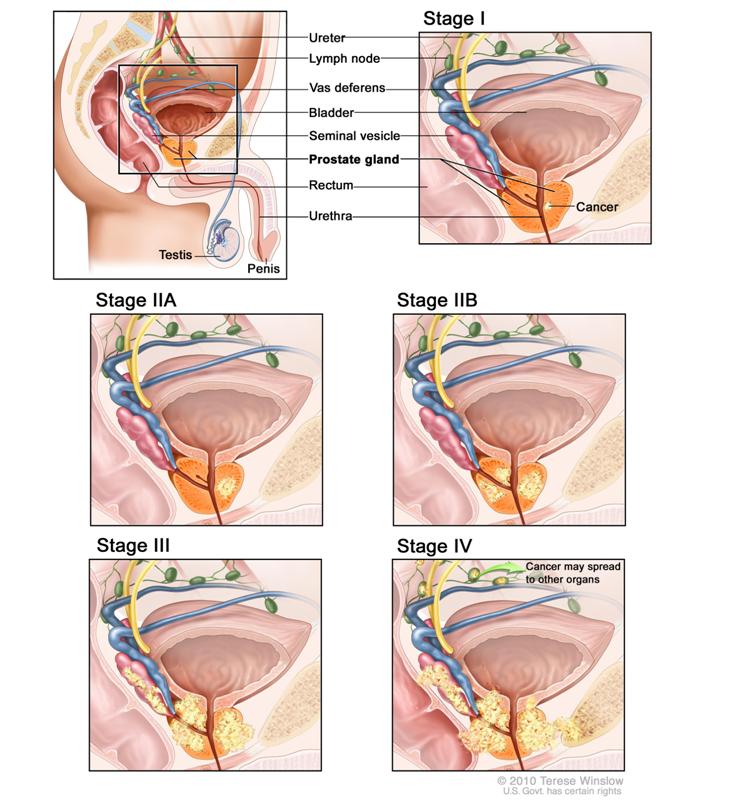 CA PROSTATE STOP 6 MIX