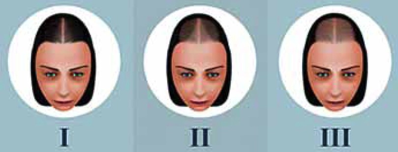 ALOPECIJA STOP 6 MIX Kompozitna formula kod alopecije MKB-10 L63