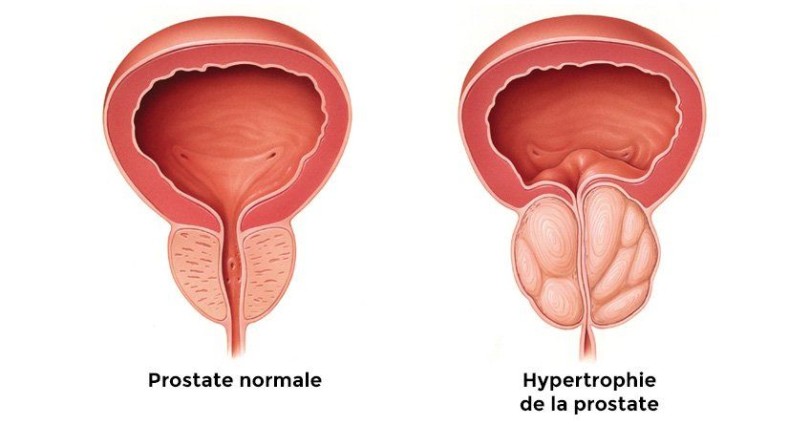 BENIGNA HIPERPLAZIJA PROSTATE (BHP) STOP 7 MIX